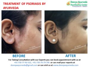 ayurvedic treatment for scalp psoriasis in india
