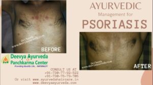 ayurvedic treatment for scalp psoriasis in india
