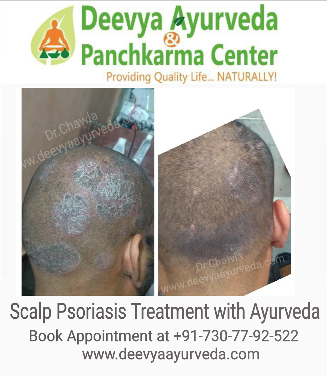 ayurvedic treatment for scalp psoriasis in india