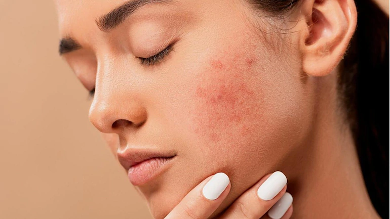 acne herbal remedies
