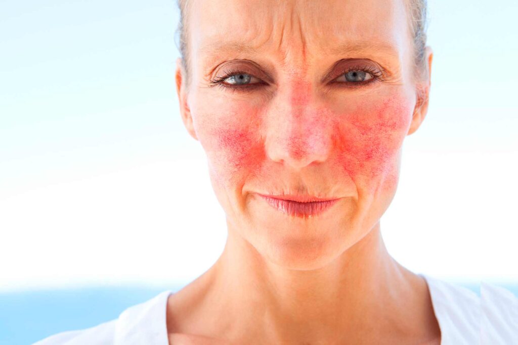 Ayurvedic Treatment for Rosacea Causes, Symptoms and Solution