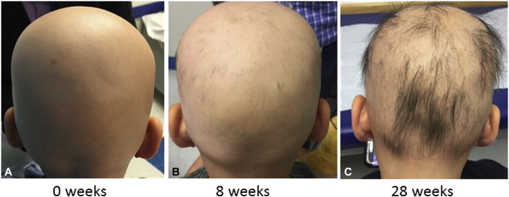 alopecia totalis ayurvedic cure