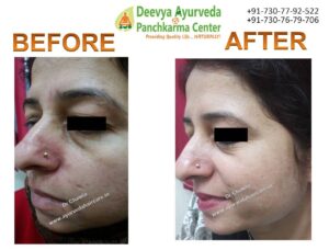 Rosacea ayurvedic treatment | Ayurvedic Rosacea treatment in India
