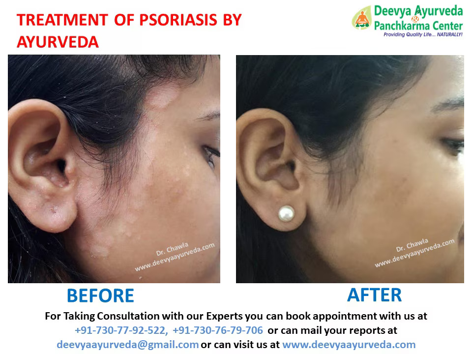 Ayurvedic Psoriasis treatment in india