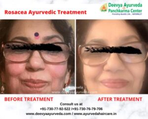 Rosacea ayurvedic treatment | Ayurvedic Rosacea treatment in India