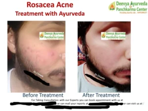 Rosacea ayurvedic treatment | Ayurvedic Rosacea treatment in India