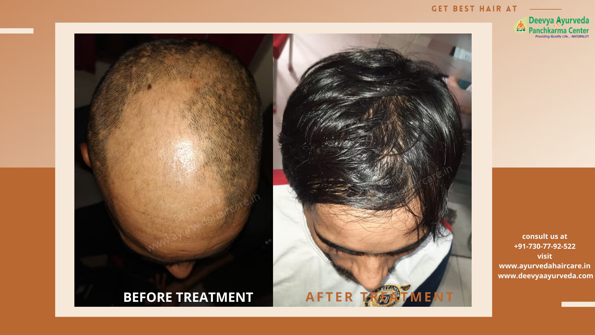 alopecia universalis