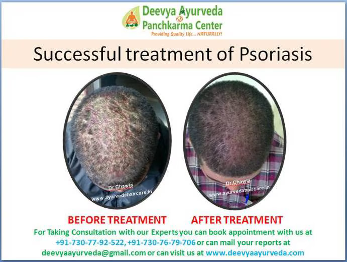 "Finding Relief from Psoriasis: Exploring Ayurvedic Treatment Options in India"