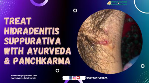 hidradenitis Suppurativa: Ayurvedic Treatment in india