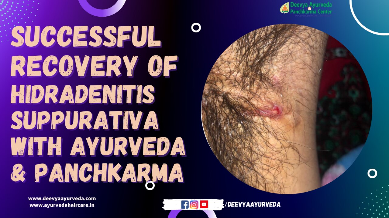 Ayurvedic Treatment for Hidradenitis Suppurativa