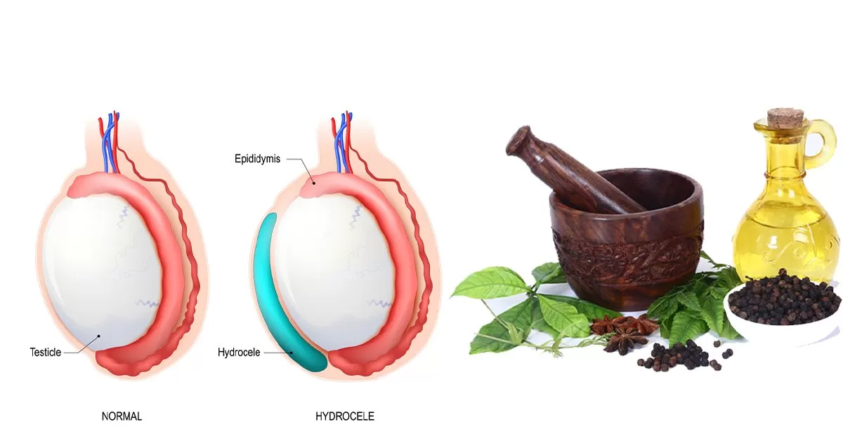 Varicocele ayurvedic treatment in India