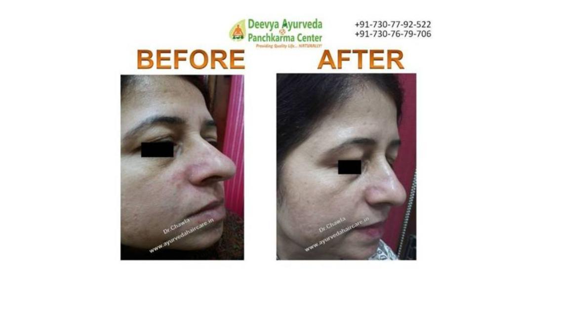 Rosacea ayurvedic treatment