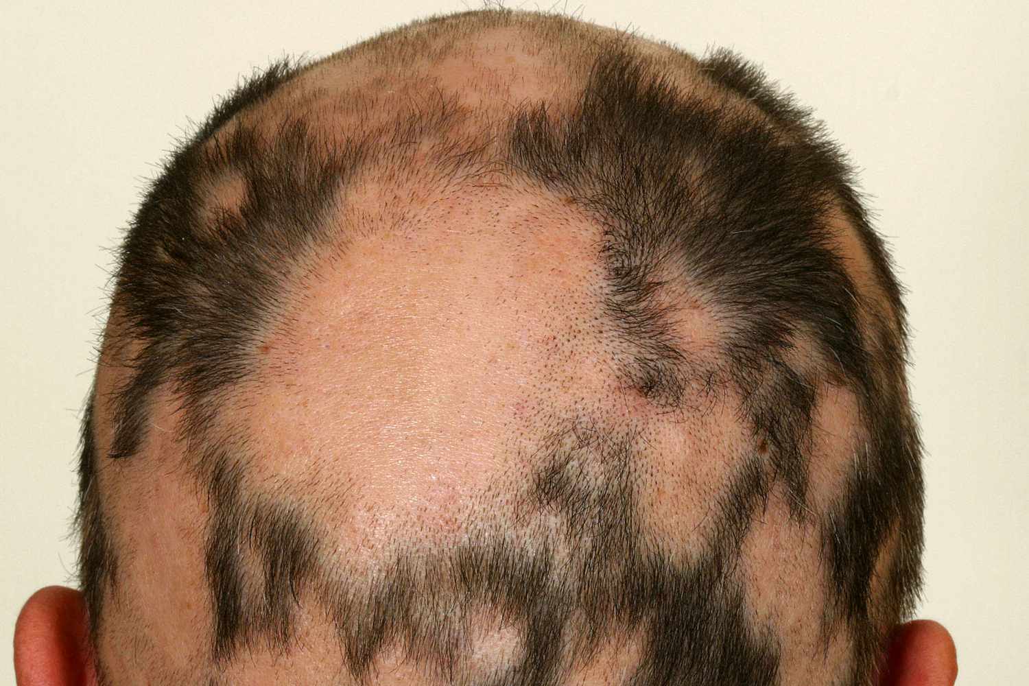 Alopecia universalis ayurvedic treatment in india